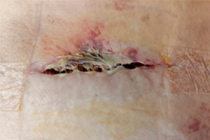 Deiscência de sutura